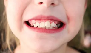 חיוך ובו רואים כמה השיניים צפופות 