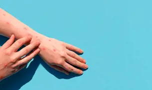 יד עם עקיצות או אבעבועות